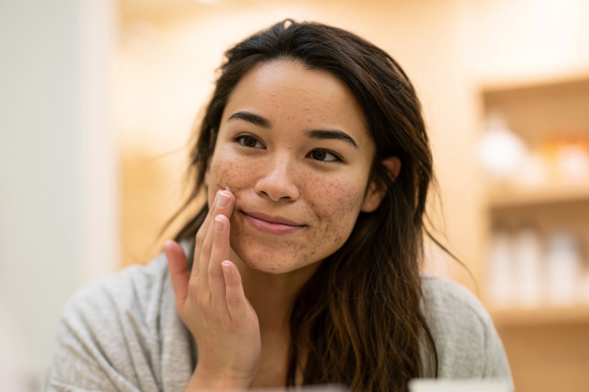hyperpigmentation statistics
