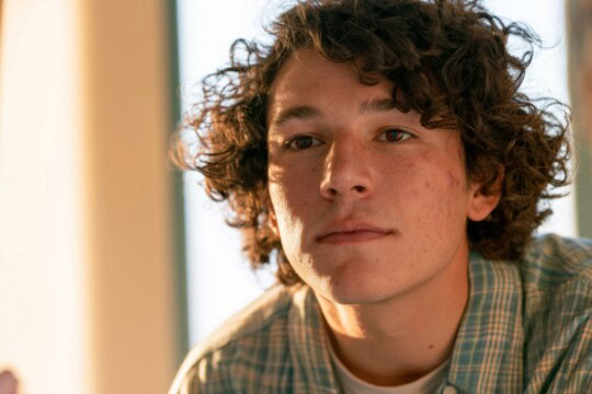 young man with acne