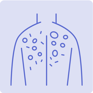 Shingles
