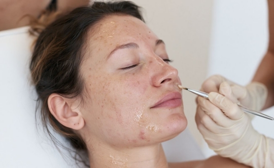 woman in a clinic to represent chemical peels for acne scars