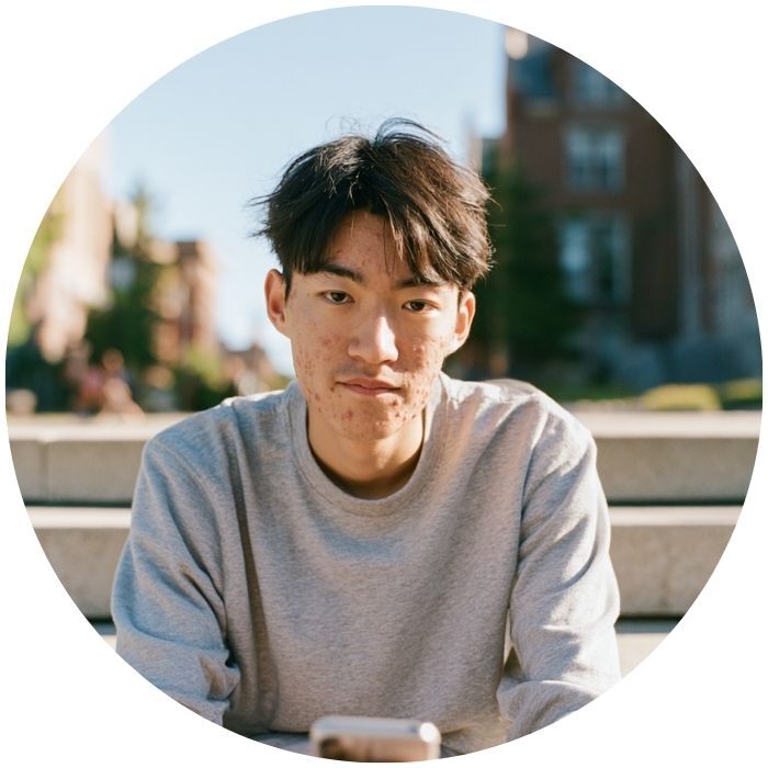 College student concerned about acne scarring