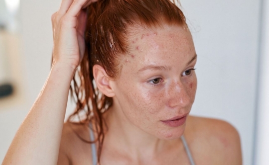 woman with pomade hairline acne