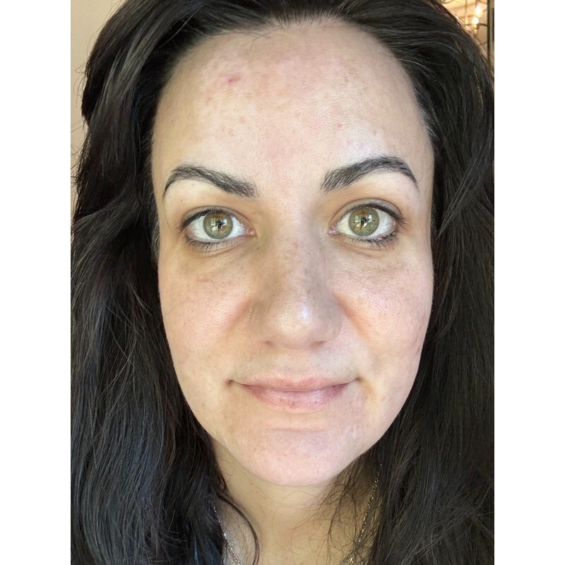 Danica’s face about 6 weeks into treatment, with lighter melasma patches