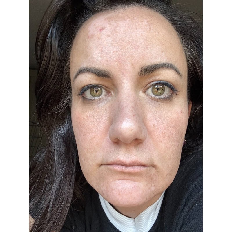Danica’s face with melasma patches before treatment