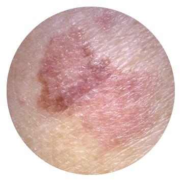 asymmetric shape of mole abcde melanoma - asymmetrical mole