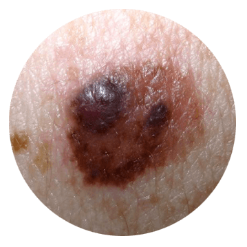 colour changes in a mole abcde of melanoma - mole changes colour