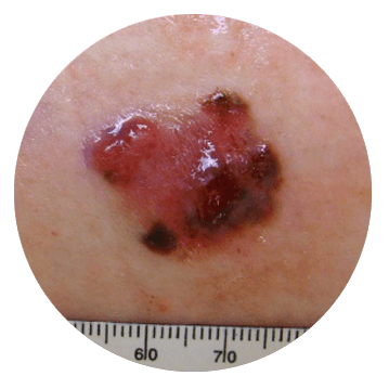 moles increase in size abcde melanoma - mole size changes