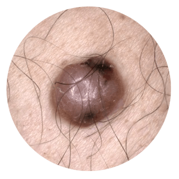Evolving moles are the potential sign of skin cancer ABCDE Skin Cancer - Mole starts to evolve
