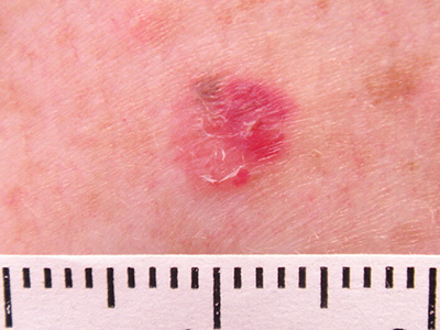 Amelanotic melanoma - a skin cancer type where the cells do not make melanin amelanotic melanoma skin cancer