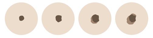 changing lesion