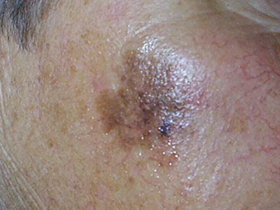 lentigo maligna melanoma