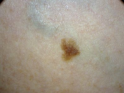 atypical junctional naevus