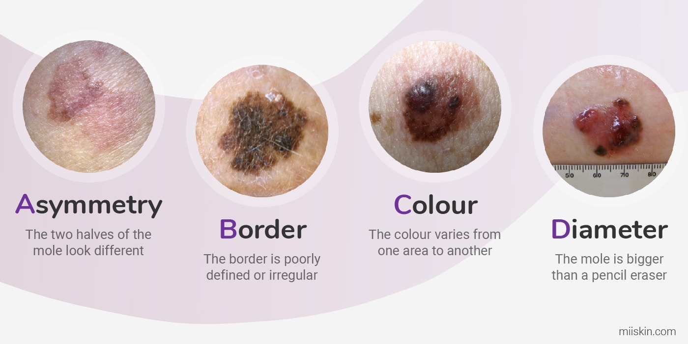 abcd rule for melanoma symptoms melanoma signs abcde rule