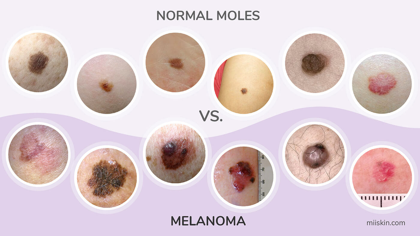 normal moles vs cancerous moles picture