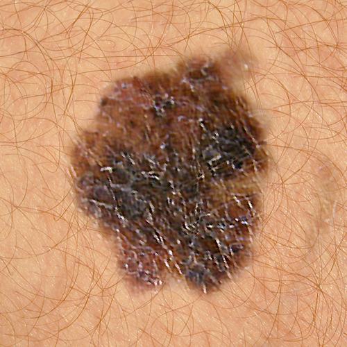 border of a mole changes abcde melanoma - change in border