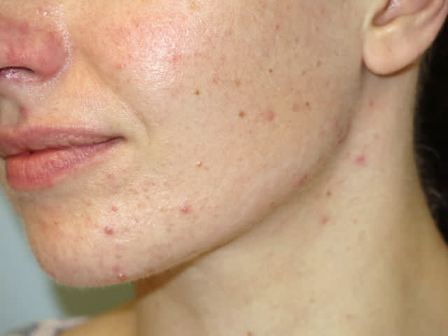 mild case acne face