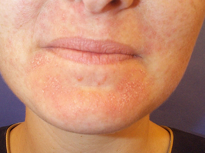 Skin Purging - What Is It and What Medicines Can Cause It?