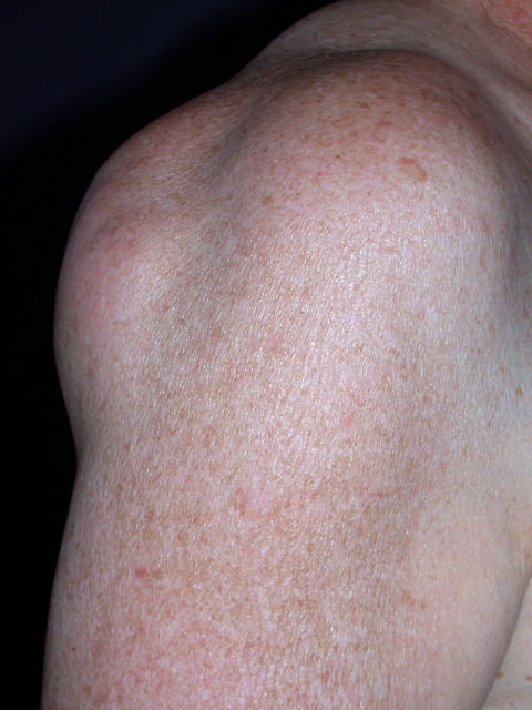 Skin Lesions: Types, Pictures & Prevention