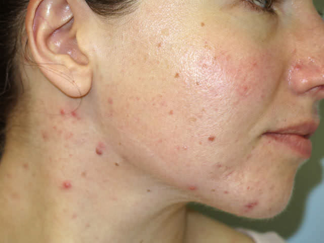 acne on the face