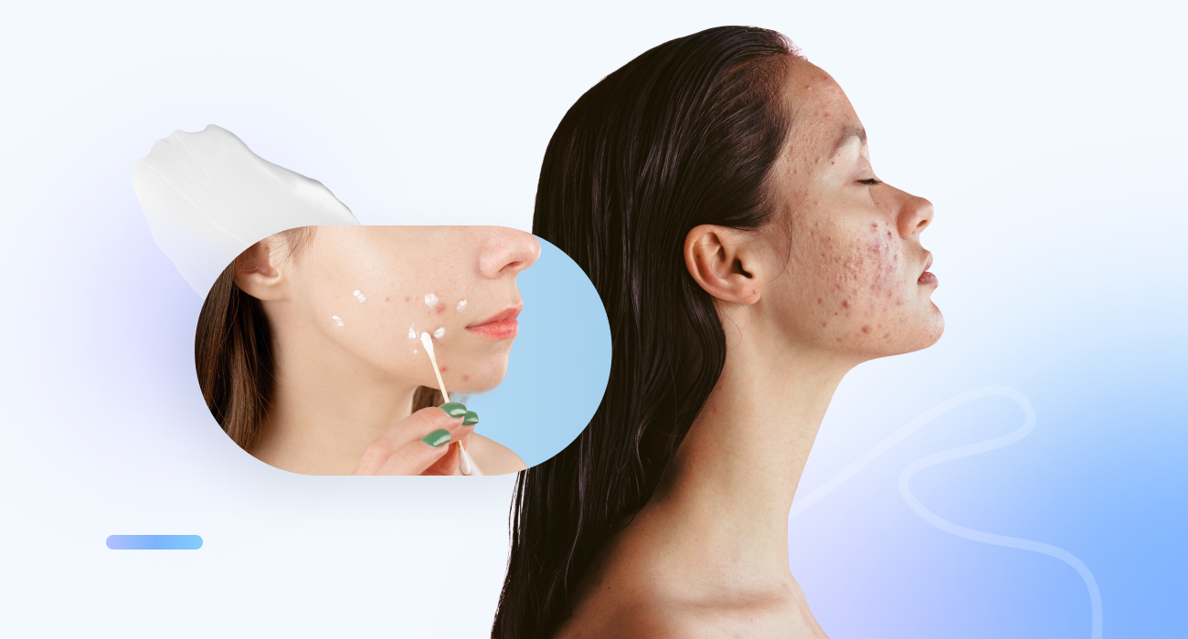 Acne-Prone Skin Care