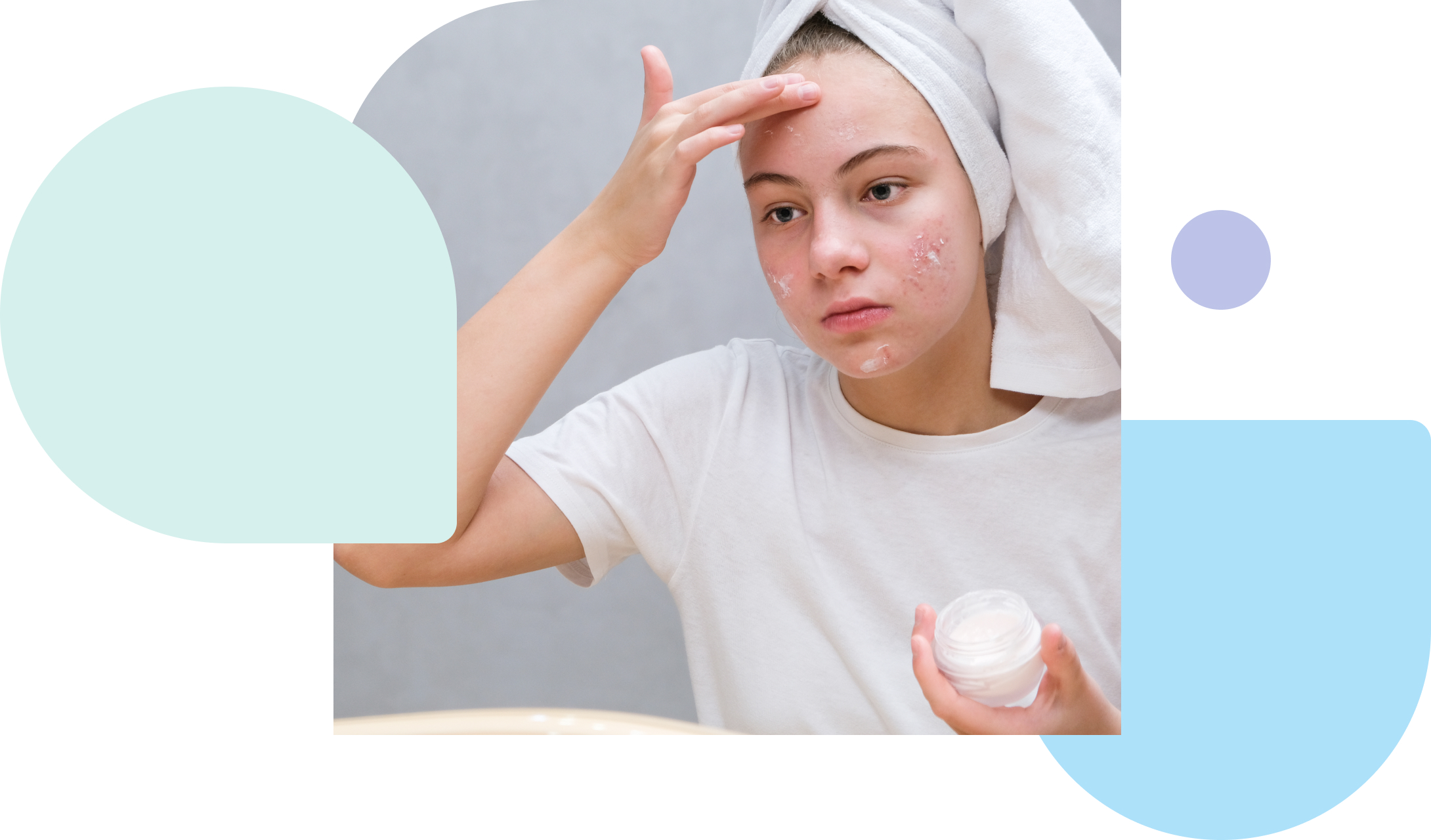 treating acne with azelaic acne