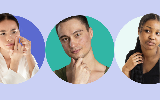 acne breakouts