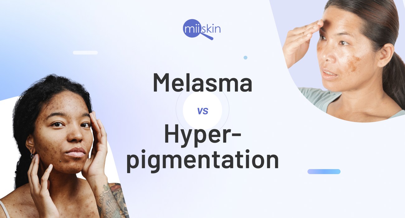 melasma and hyperpigmentation skin conditions