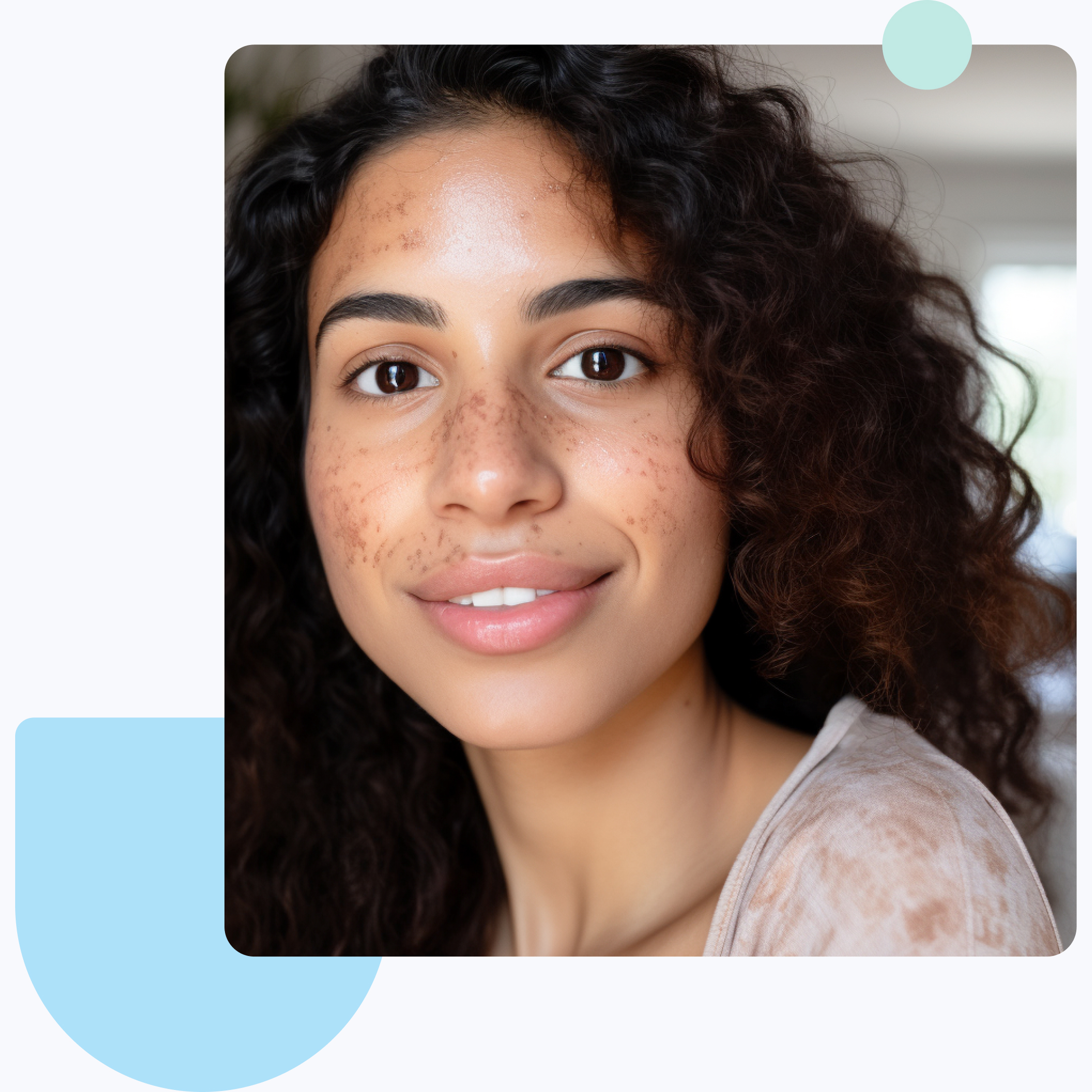 hyperpigmentation statistics