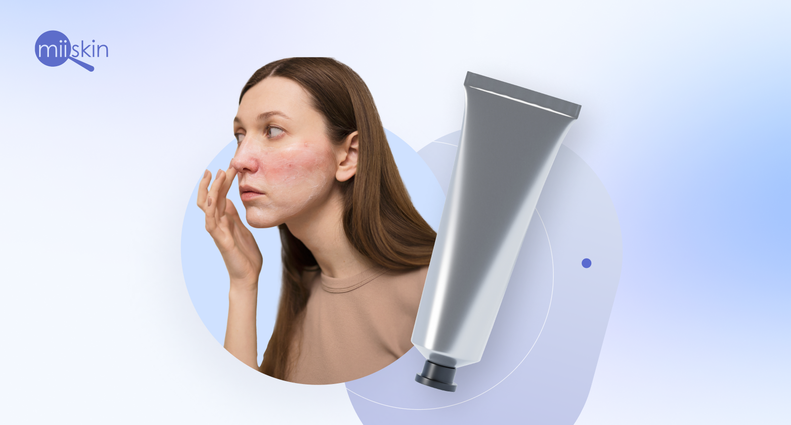 dermatitis seborreica