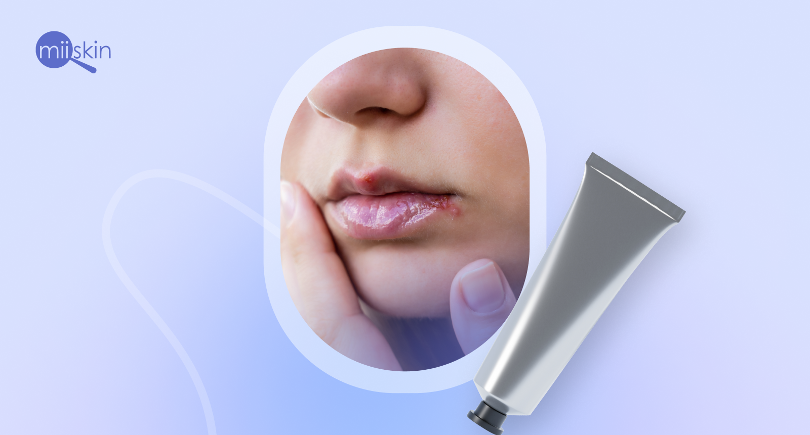 herpes labial fuego-en-la-boca