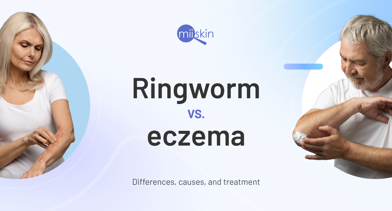 the difference and similarities between ringworm and nummular eczema nummular eczema vs ringworm