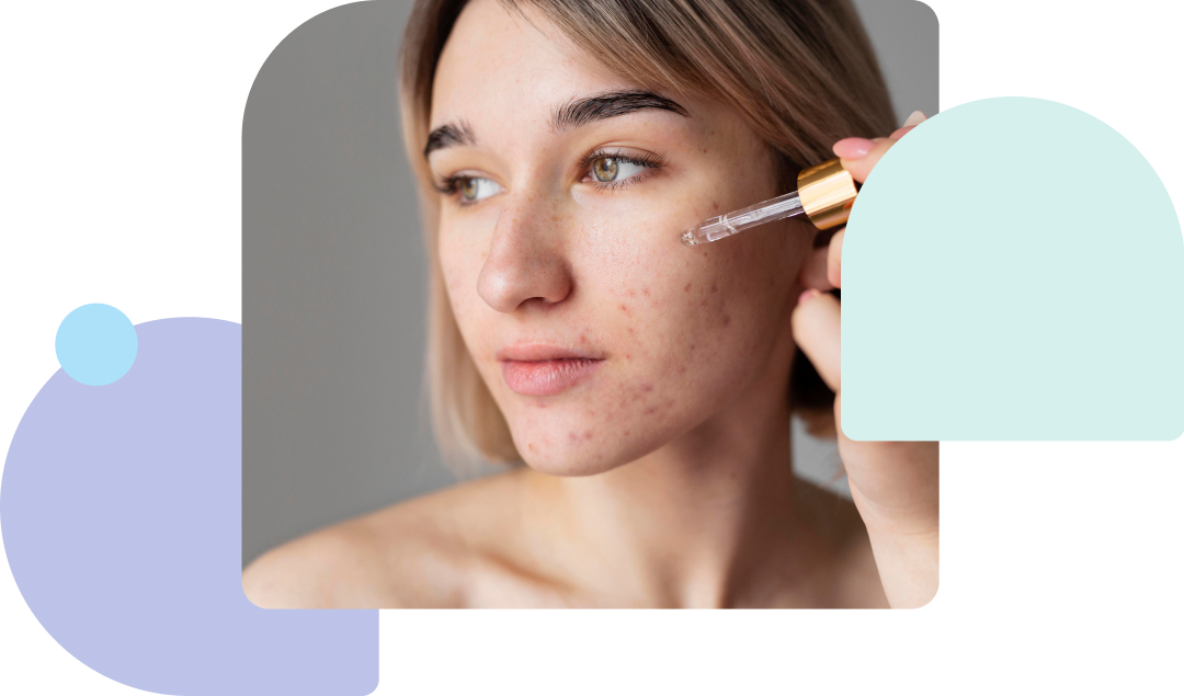 strategies for reducing the duration and severity of the tretinoin purge