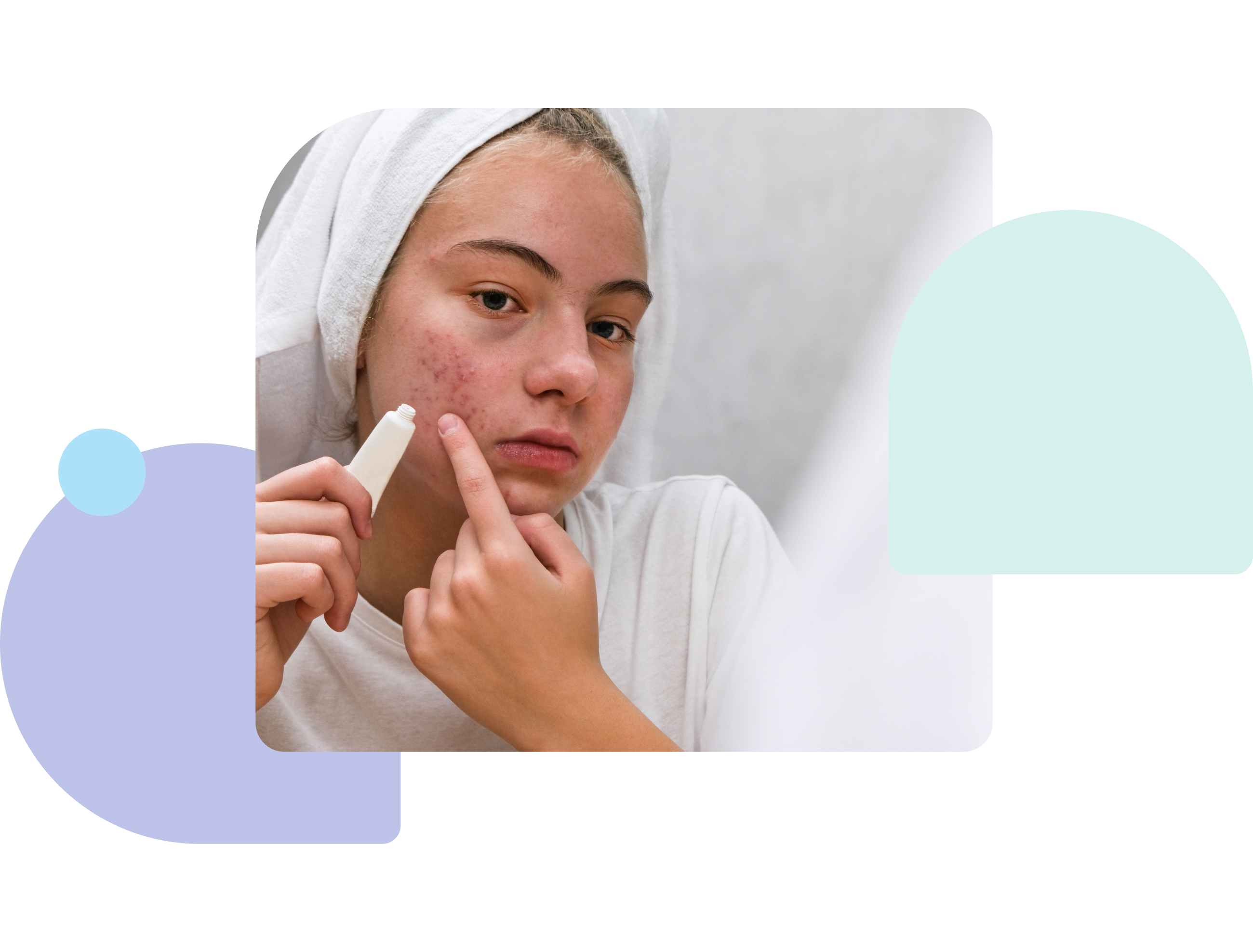 ways to lessen the intensity of tretinon reduction of tretinon severity