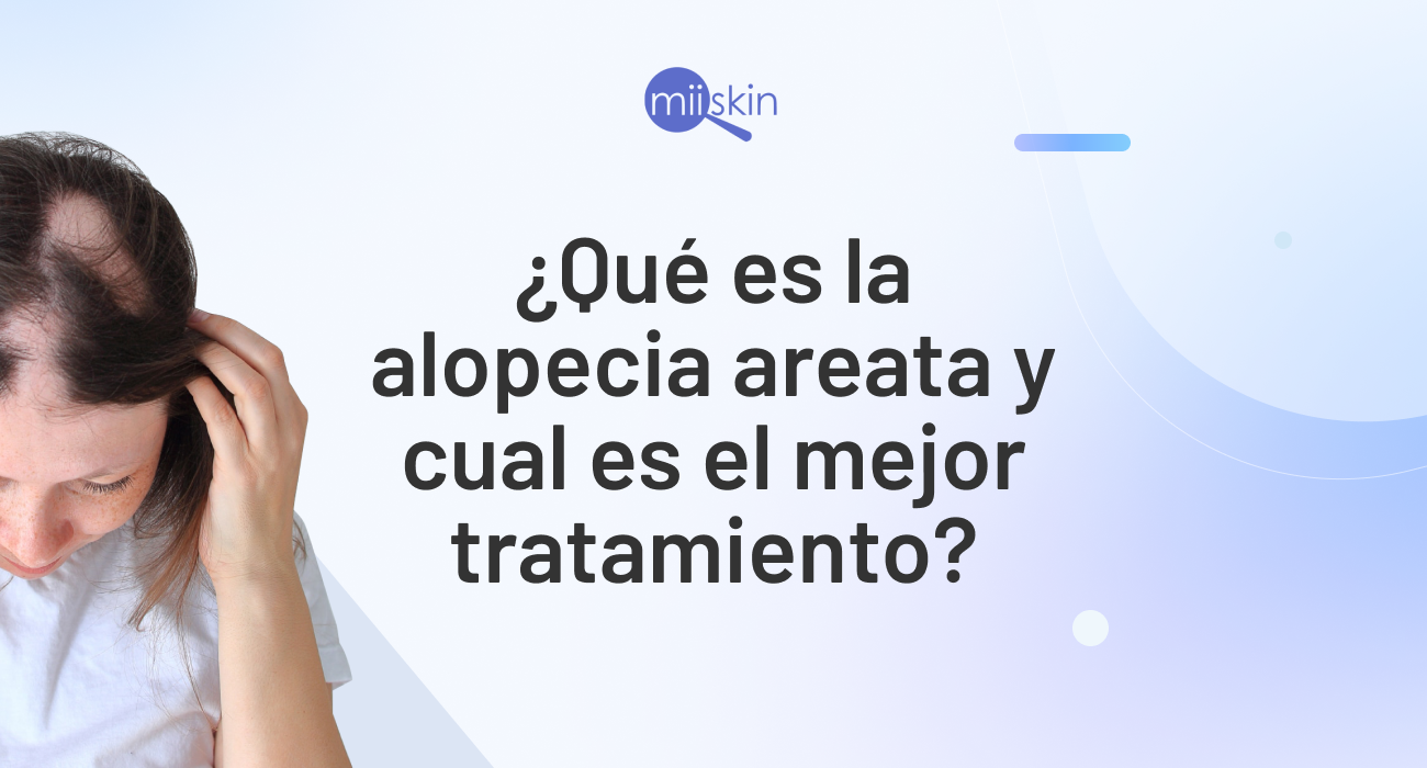 tratamiento alopecia areata