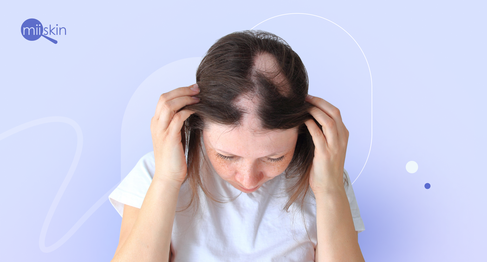 alopecia areata tratamiento