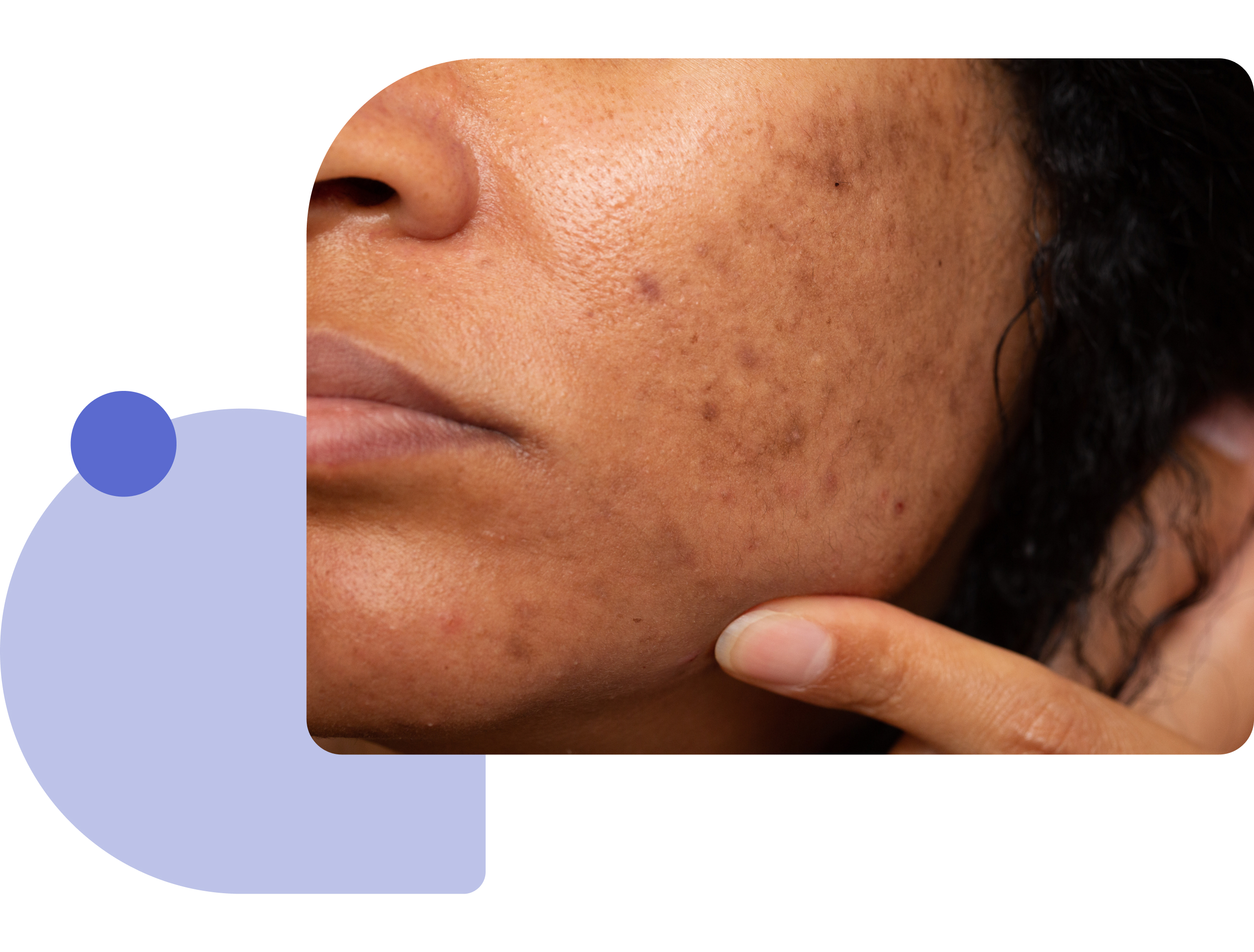 explicación del melasma