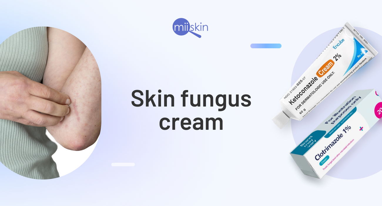 antifungal creams