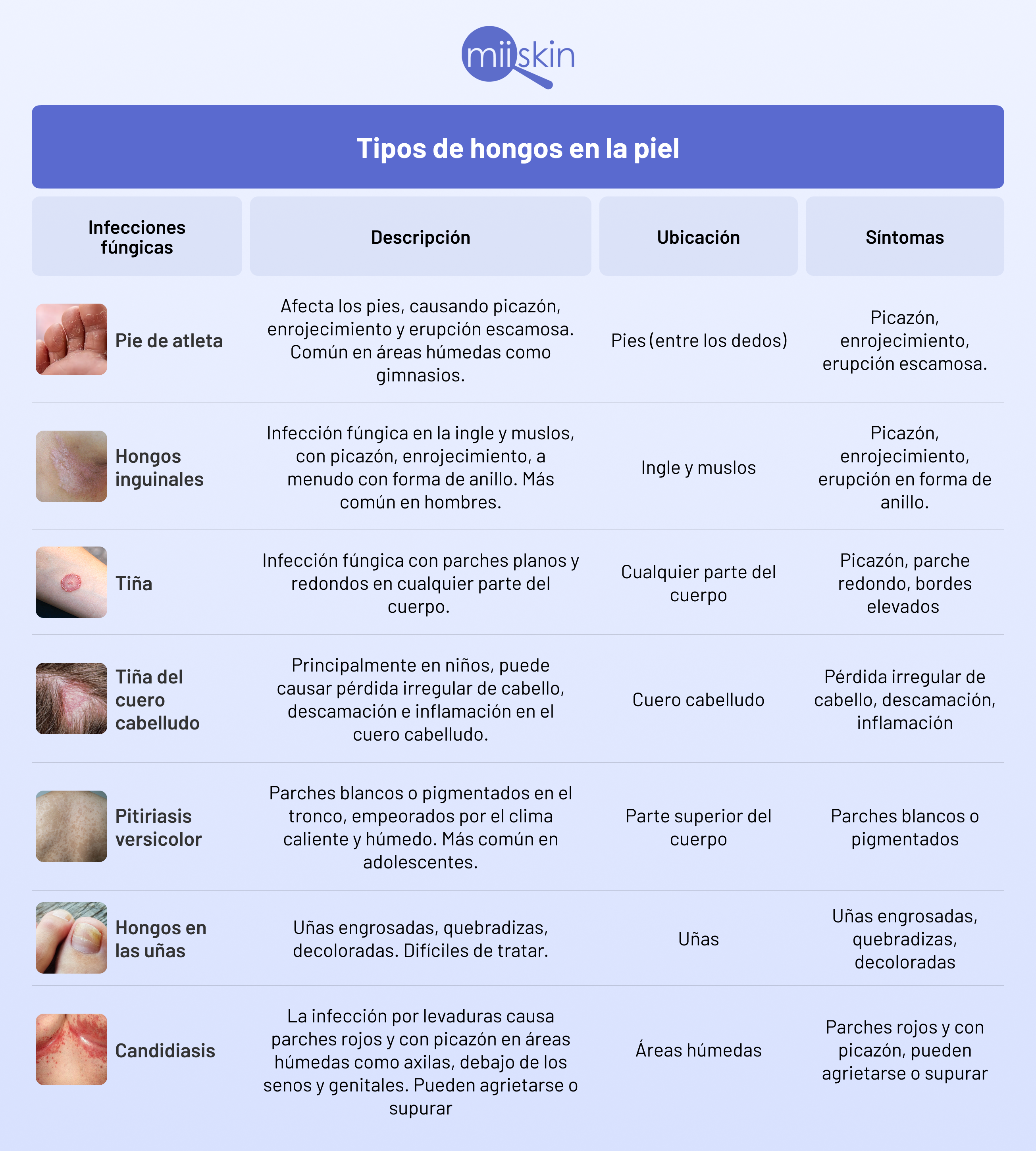 tipos de infecciones fungicas