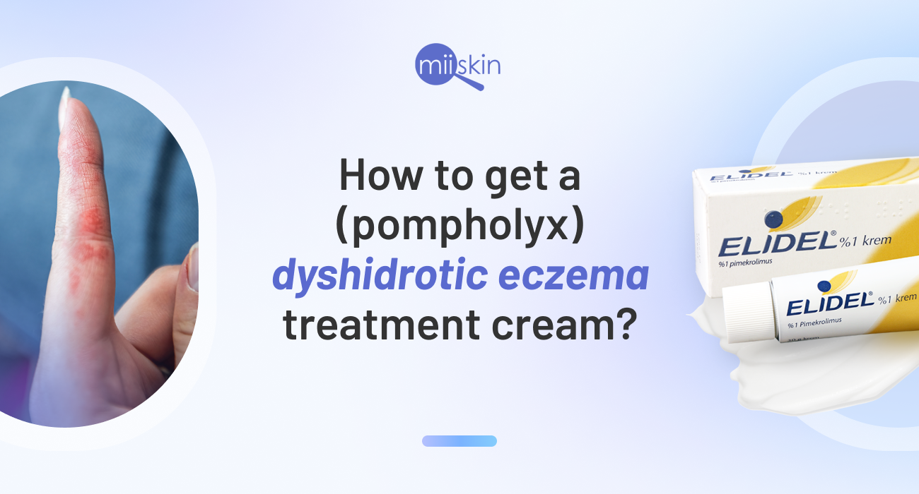 dyshidrotic eczema treatment cream image showing eczema on hand and asking how to get dyshidrotic eczema treatment cream