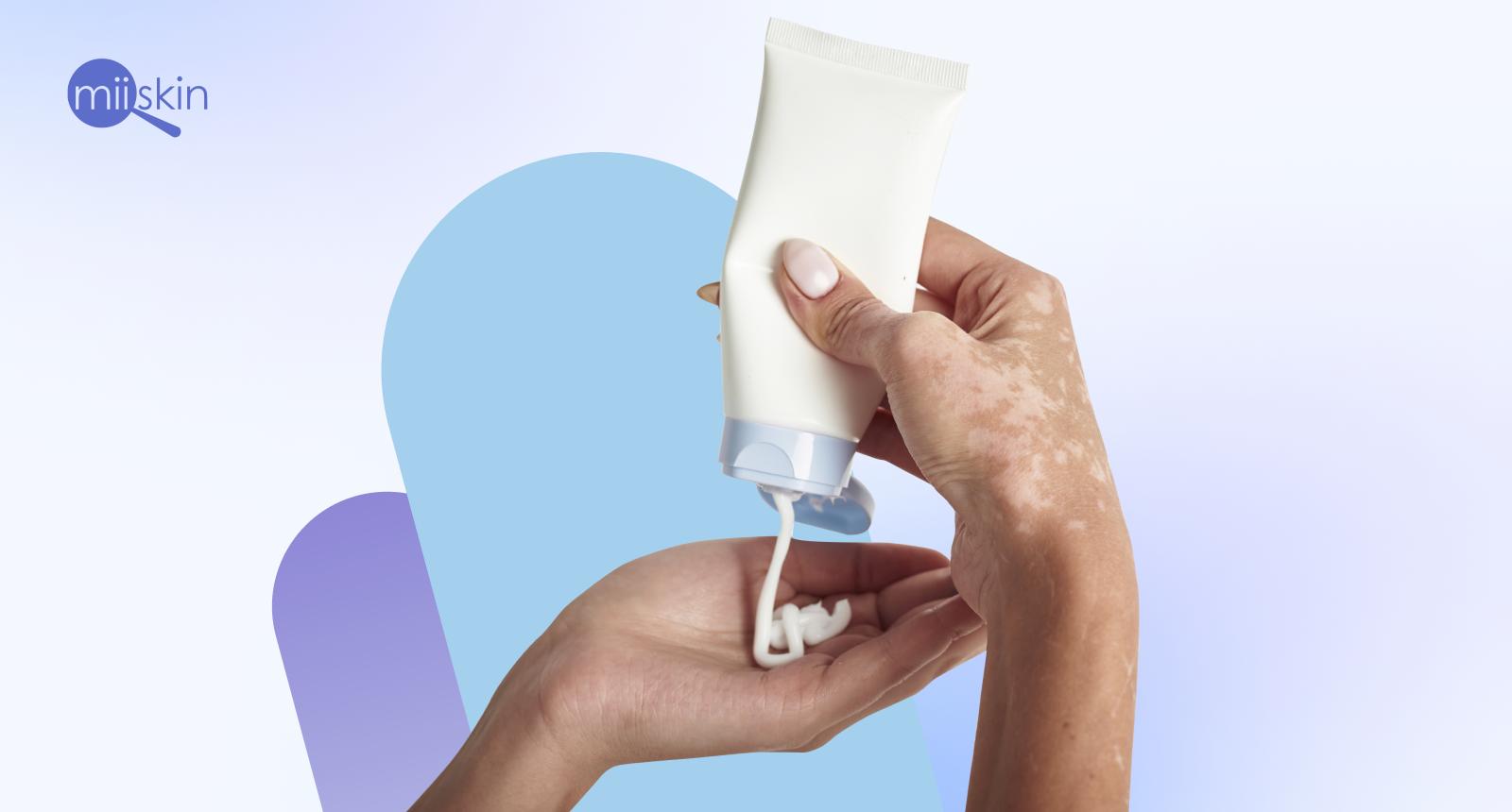tratamiento para vitiligo