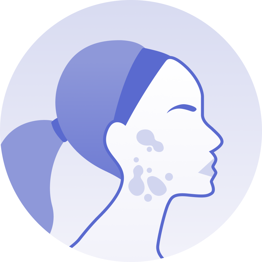 hormonal acne treatment