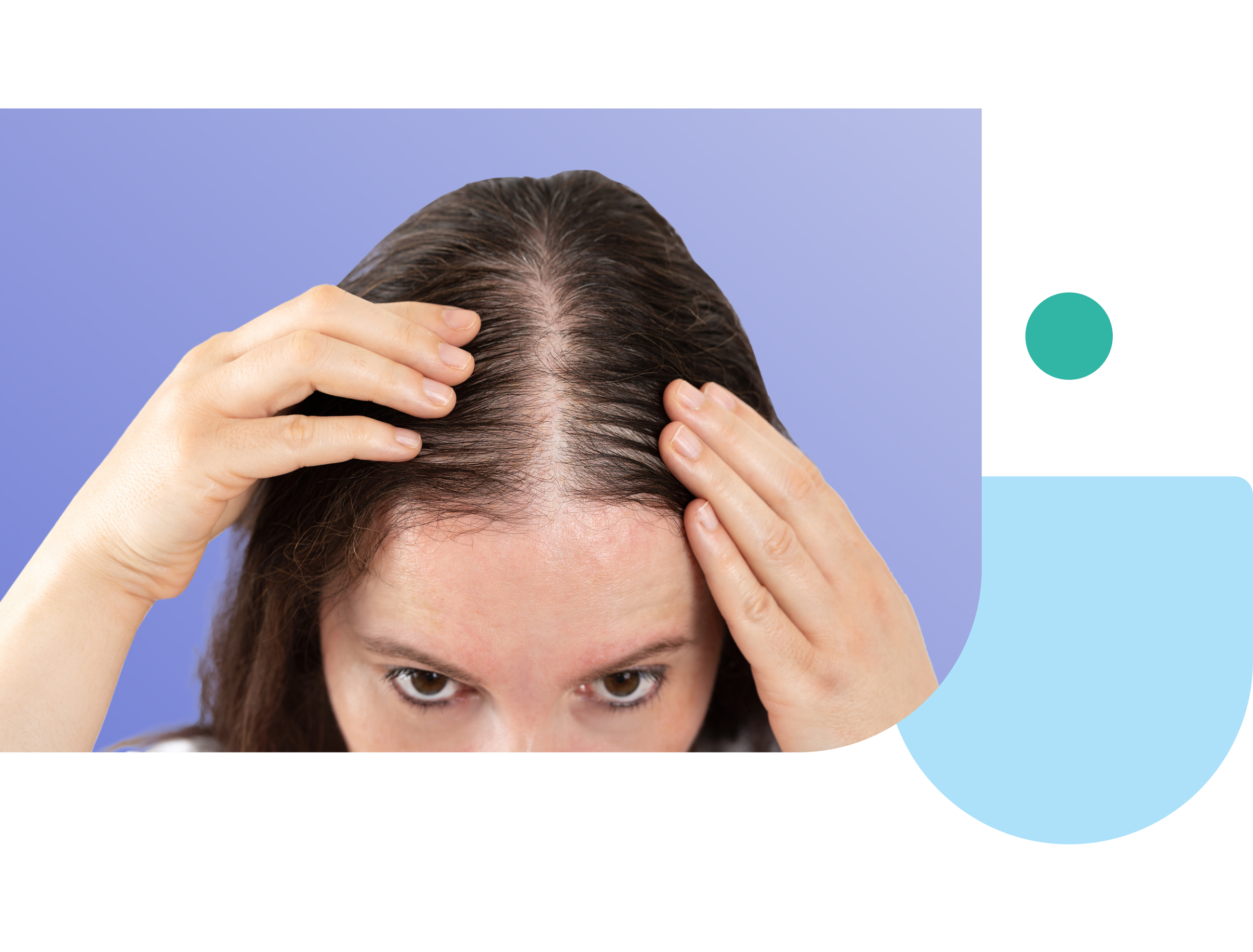 dutasteride and minoxidil topical solution usage