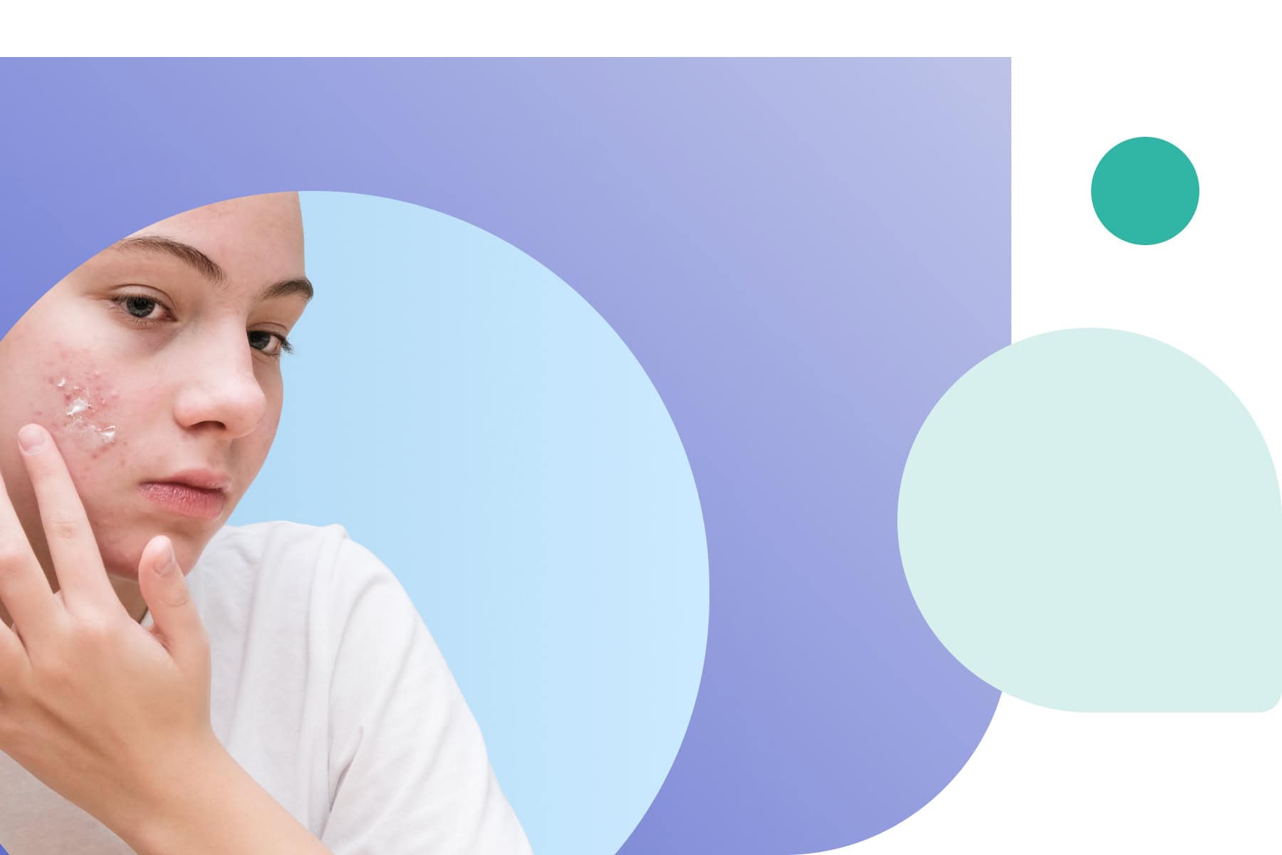 a girl using azelaic acid 20 for acne