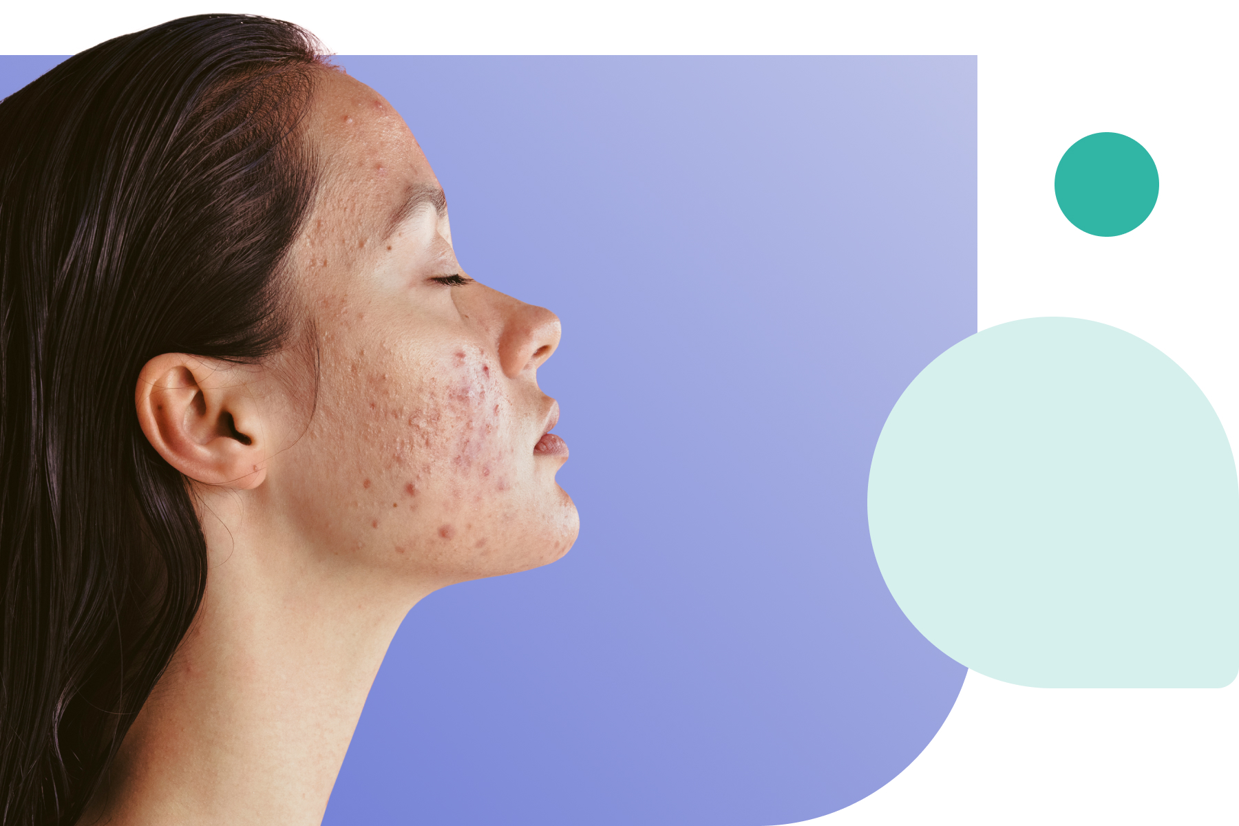 what is accutane for acne treating acne with accutane