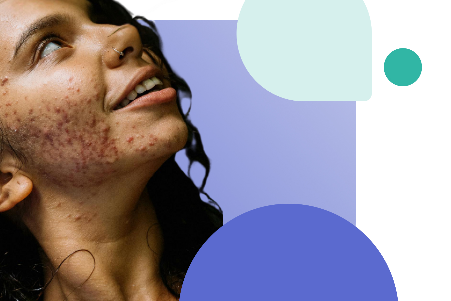 isotretinoin purge accutane purge