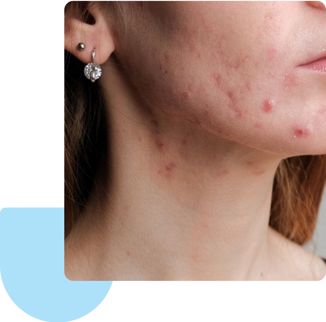 when is accutane prescribed treating skin acne with accutane