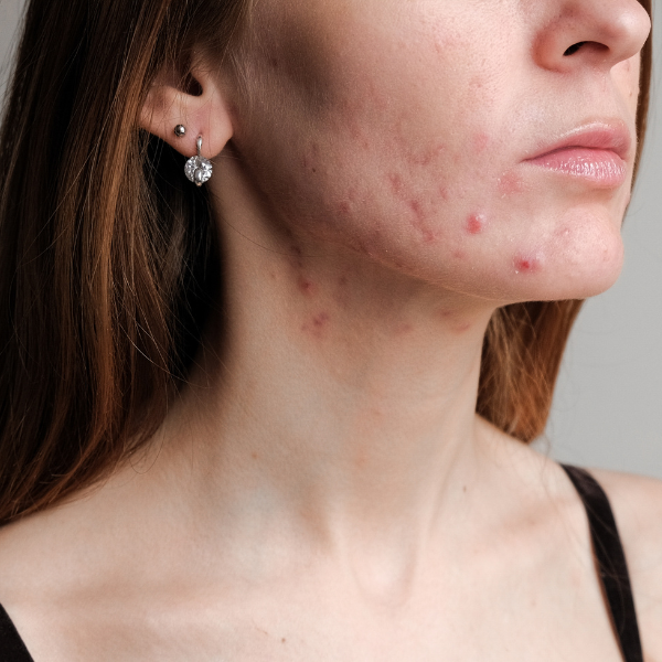 acne