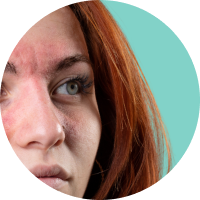 demodex mites may cause rosacea