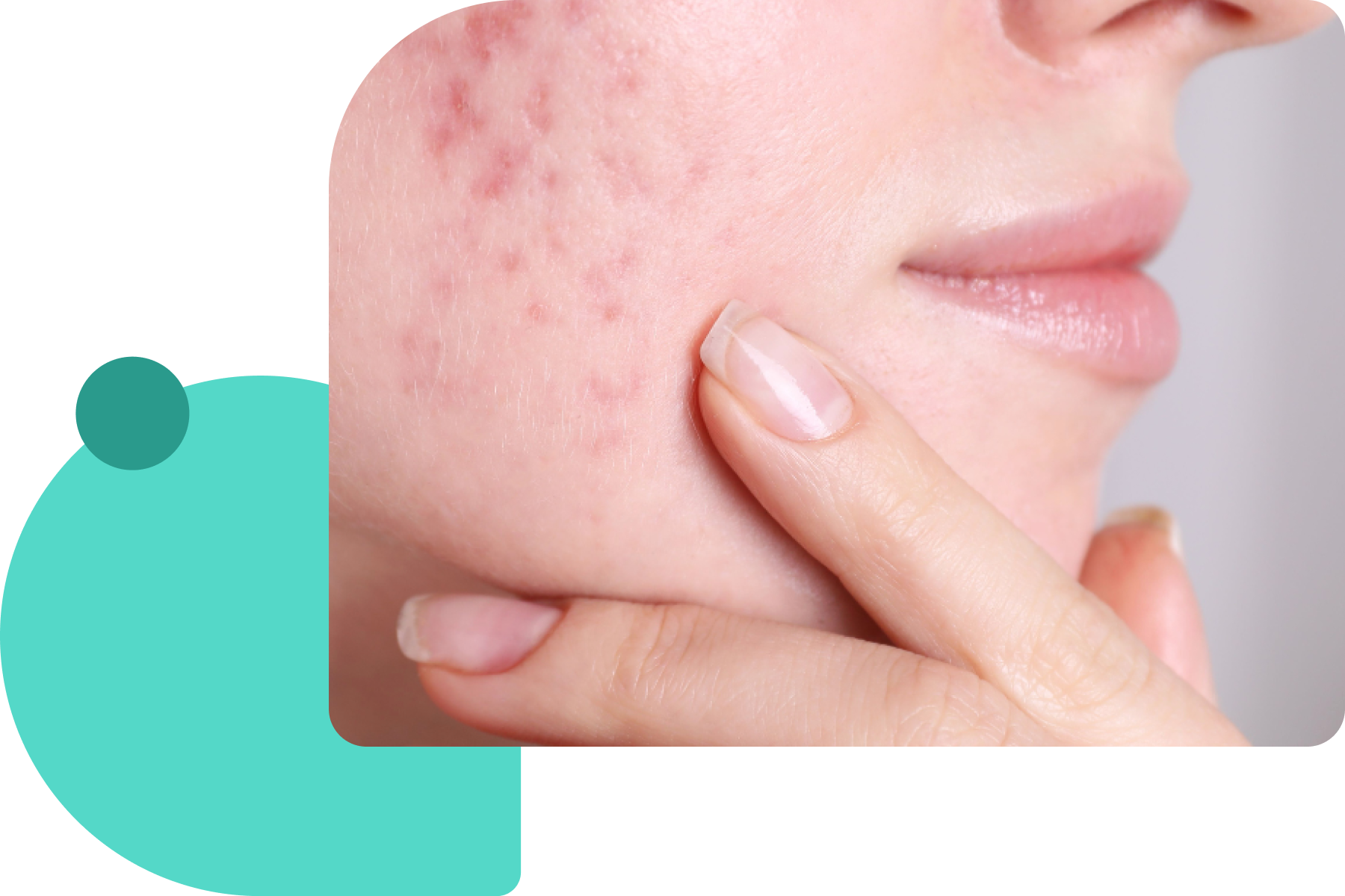 Dermatologist-recommended evidence-based treatment for rosacea flare-ups
