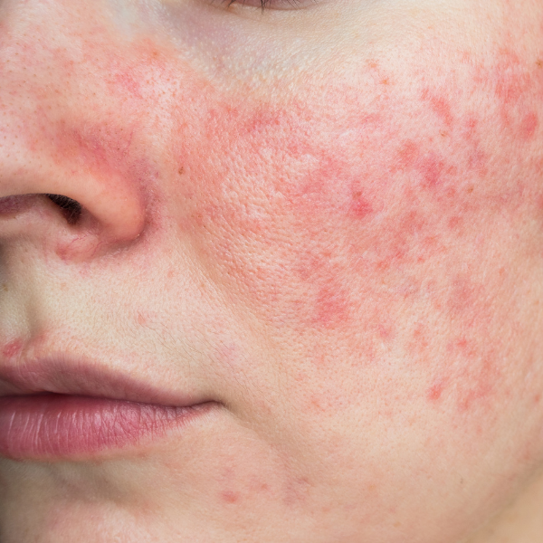 rosacea
